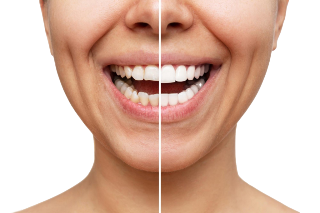 A comparison of porcelain veneers before and after