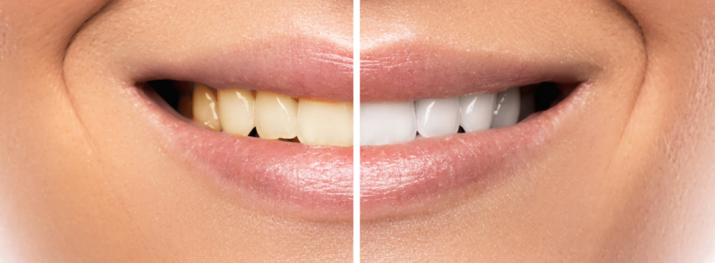 Whitening Before and After - Smile Science Dental Spa - Glendale, AZ