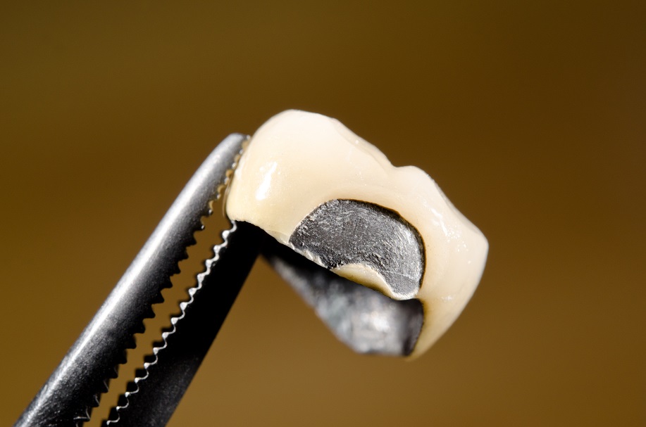 A broken dental crown showing fractured porcelain and metal framework underneath