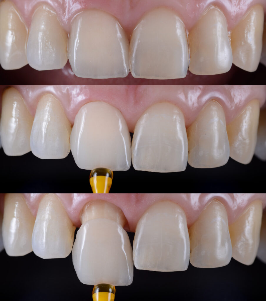 Seating a porcelain crown on a central incisor