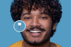 Implant Dentistry in Glendale, AZ | Smile Science Dental Spa 36 A smiling man with a dental implant on a front tooth.