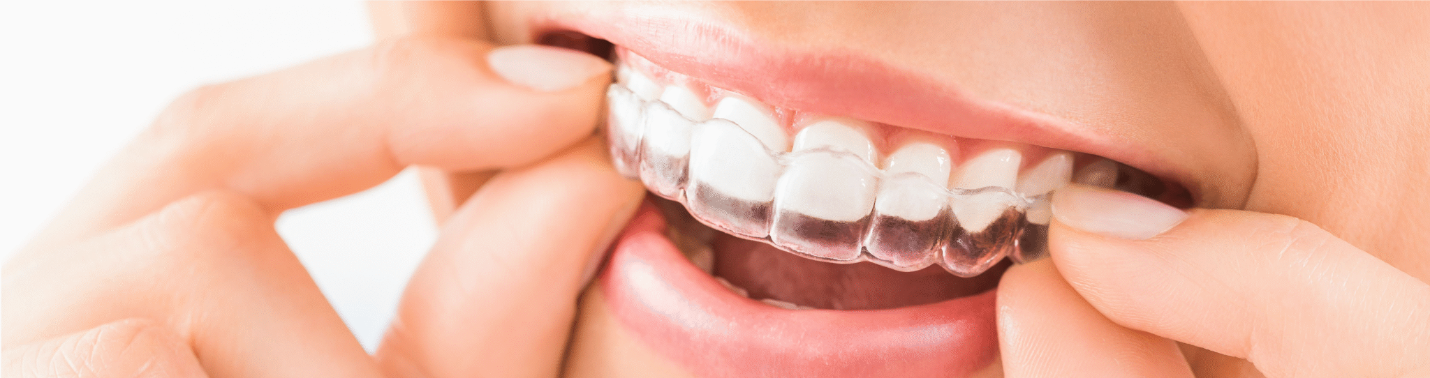 Woman placing an Invisalign clear aligner tray on her teeth.