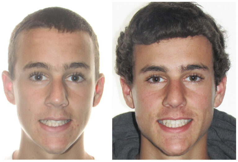Life After Invisalign: Retainers & Maintenance