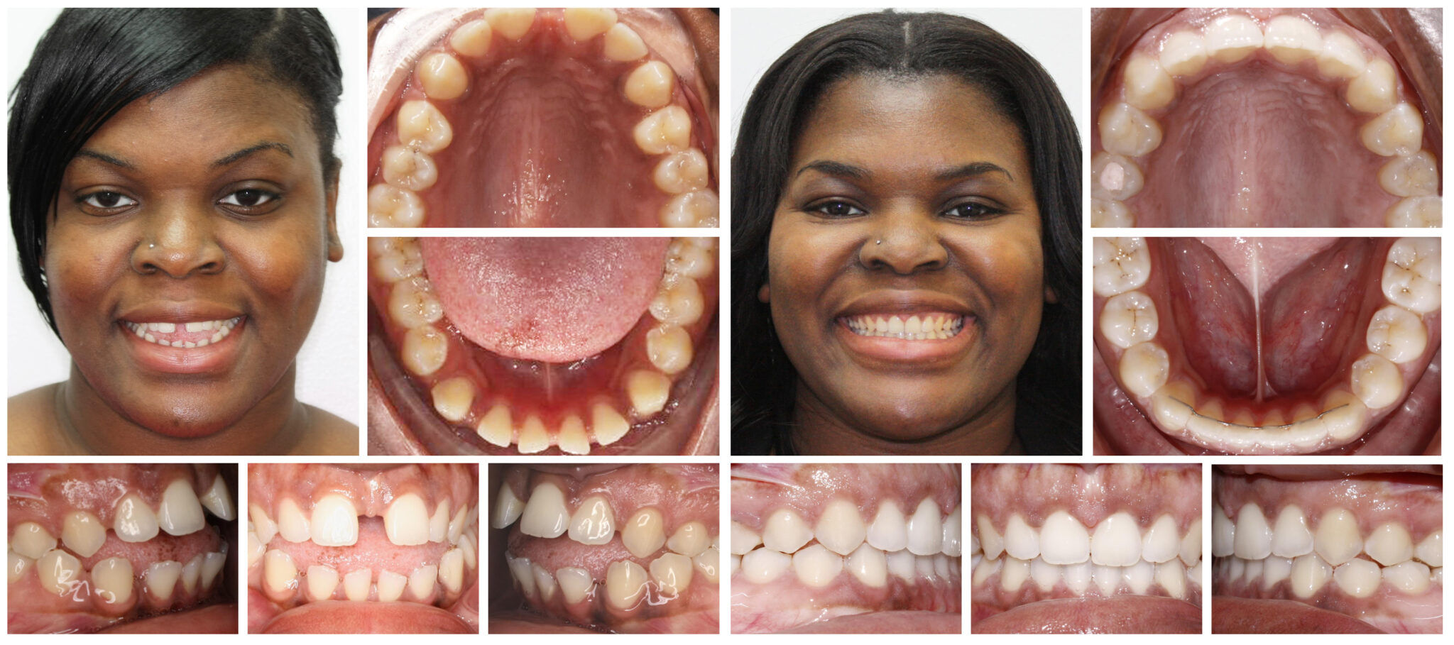 Invisalign treatment result at Smile Science Dental Spa, Glendale AZ