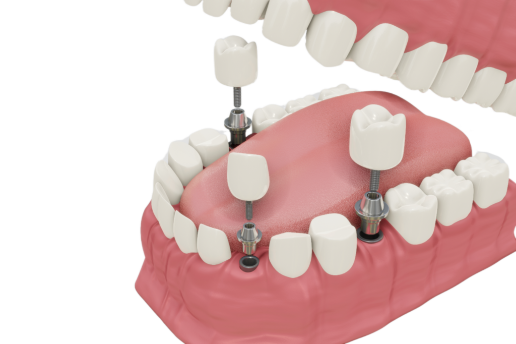 Dental Implants - Smile Science Dental Spa - Glendale, AZ