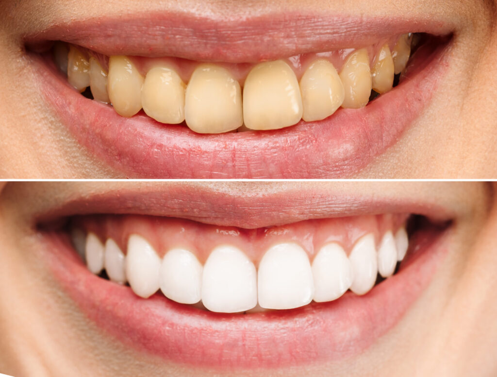 Whitening Before and After - Smile Science Dental Spa - Glendale, AZ