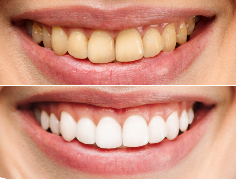 Is Teeth Whitening Right for You? Explore Stain Solutions