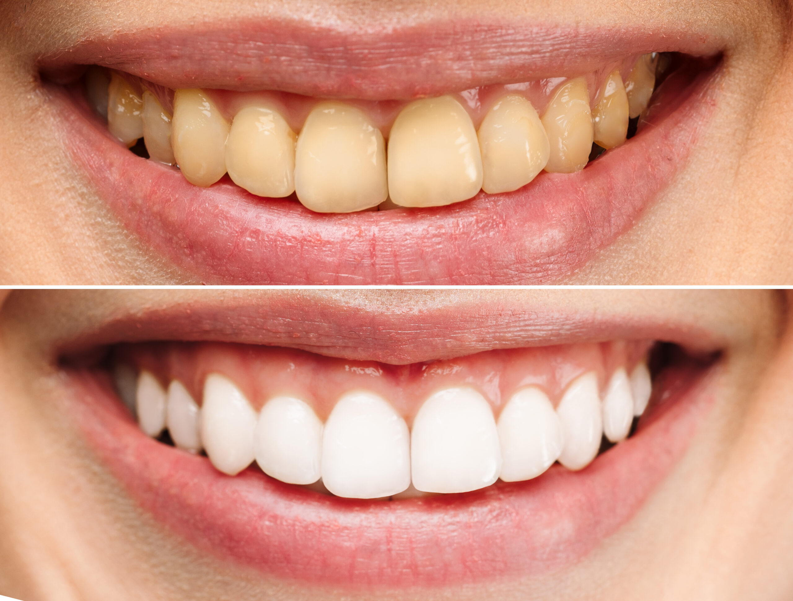 Whitening Before and After - Smile Science Dental Spa - Glendale, AZ