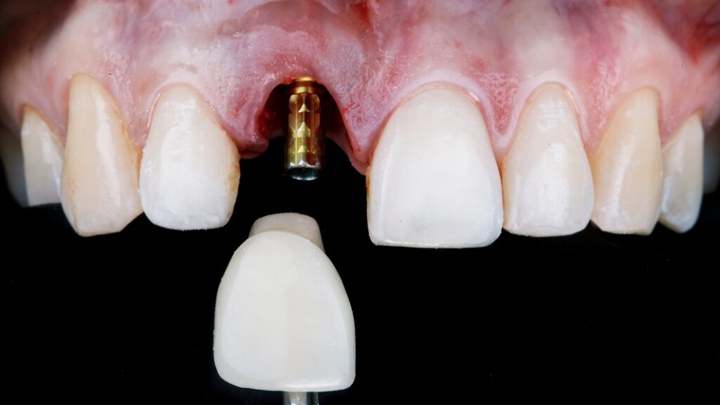 Dental Implant - Front Tooth - Smile Science Dental Spa - Glendale, AZ
