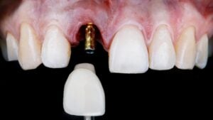 Implant Dentistry in Glendale, AZ | Smile Science Dental Spa 34 single dental implants in glendale az