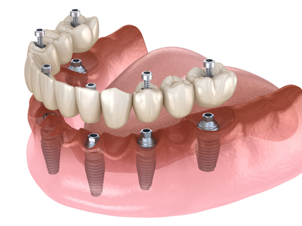 Fixed Implant Overdenture - Smile Science - Glendale, AZ