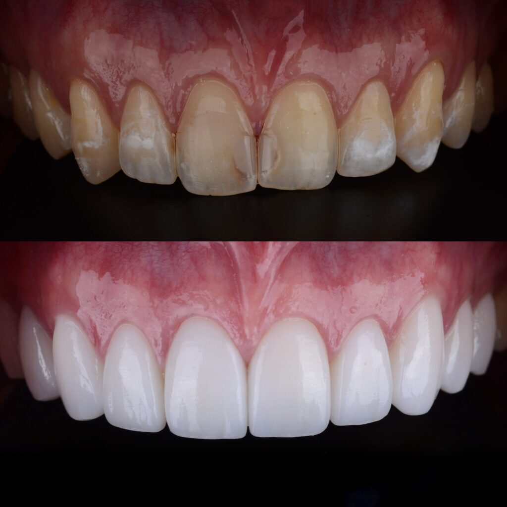 Cosmetic Veneers in Glendale, AZ 1 Cosmetic Veneers Before and After - Smile Science - Glendale, AZ