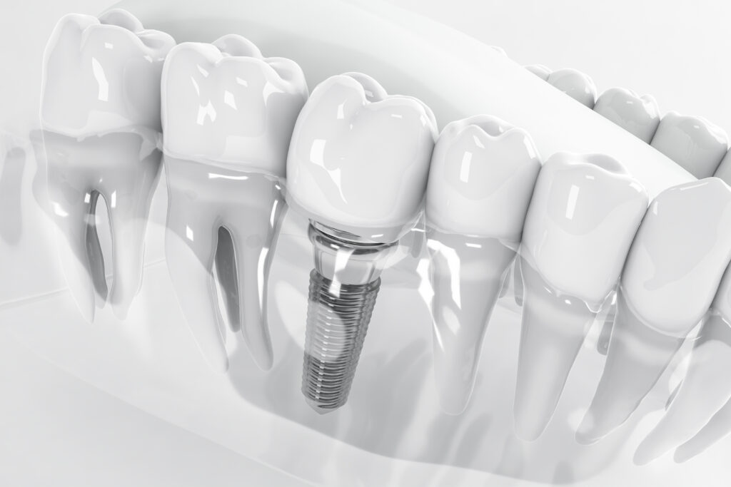 A 3D illustration of a dental implant in transparent gum and bone tissue