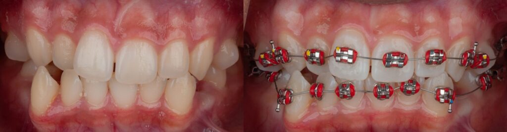 Braces - Smile Science - Glendale, AZ