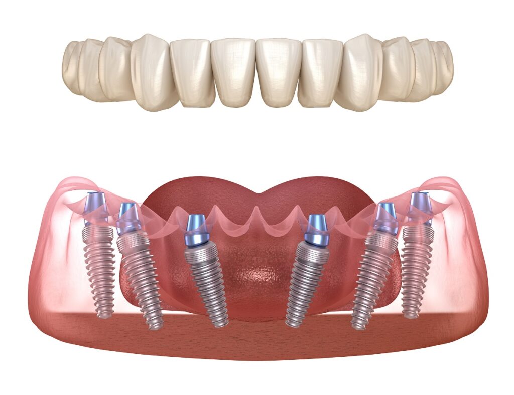 3D Rendering of All-on-6 Fixed Implant Denture