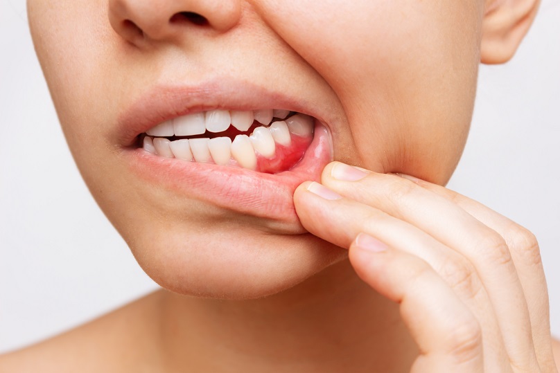 Woman pulling down lower lip to reveal red gums, inflammation, gum disease, compromised oral health