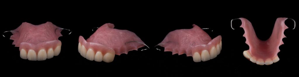 Partial Dentures | Smile Science Dental Spa | Glendale, AZ 1 Upper Acrylic RPD with Metal Clasps