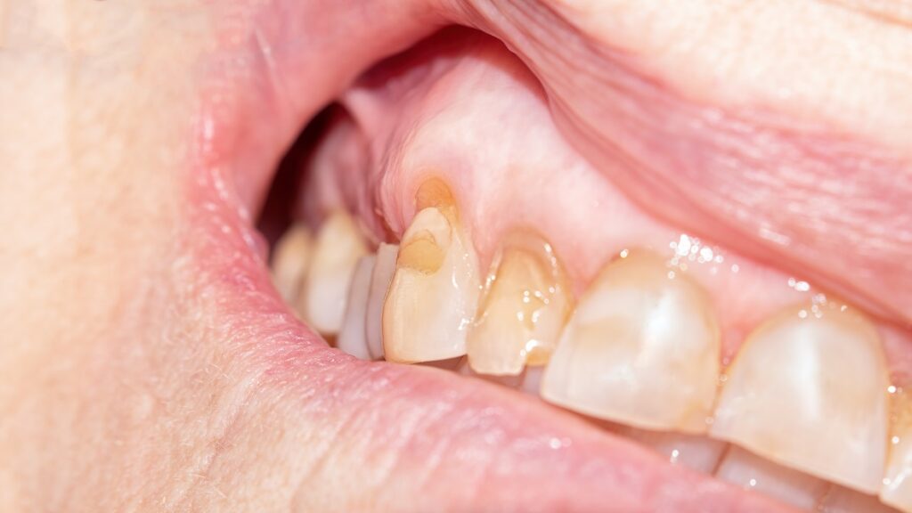 Worn dentition that is the result of teeth grinding / bruxism.