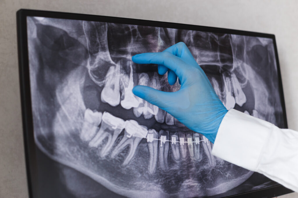 A dentist's gloved hand indicates the fill of a root canal treatment on x-ray