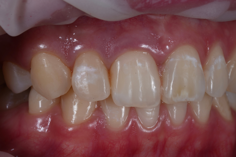 A closeup of teeth with dental fluorosis