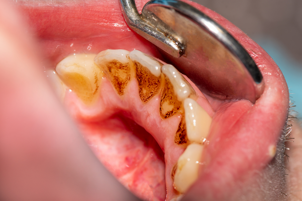 Teeth with tobacco staining