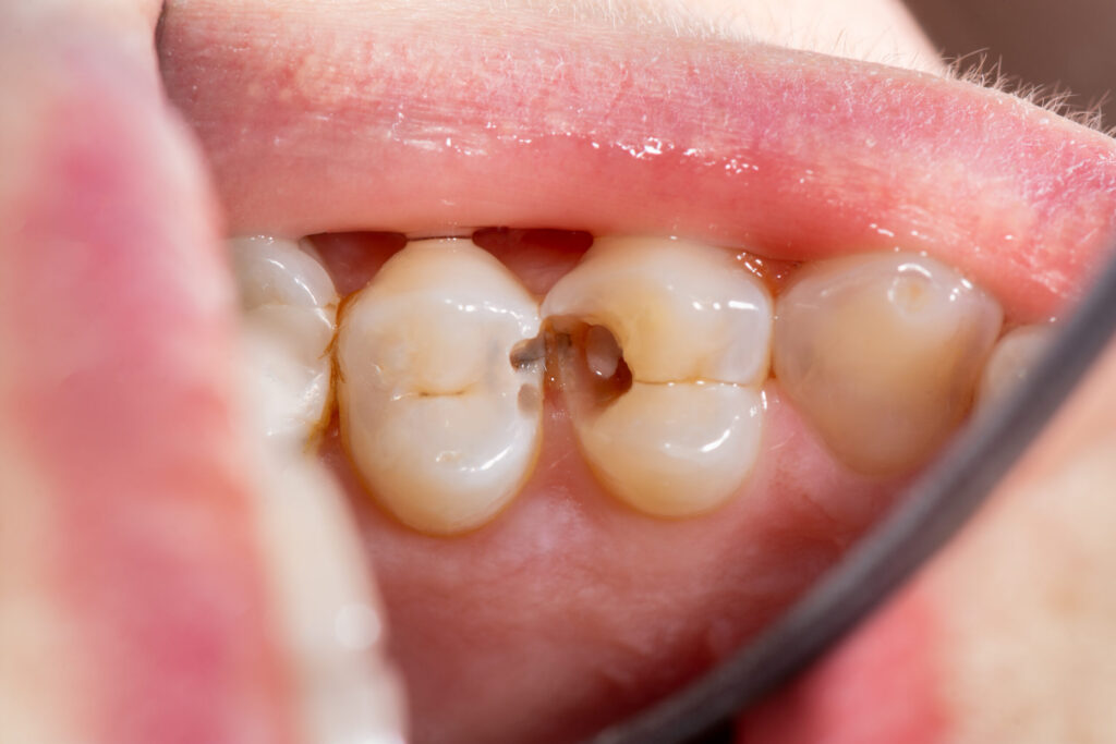 A tooth with a large cavity