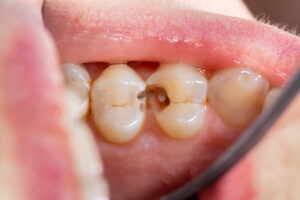 A tooth with a large cavity