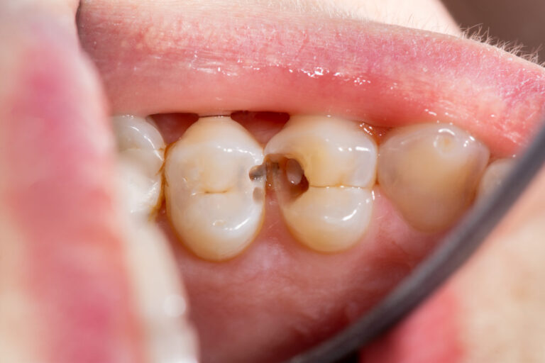 Tooth Decay: How it Happens, and Ways We Can Help