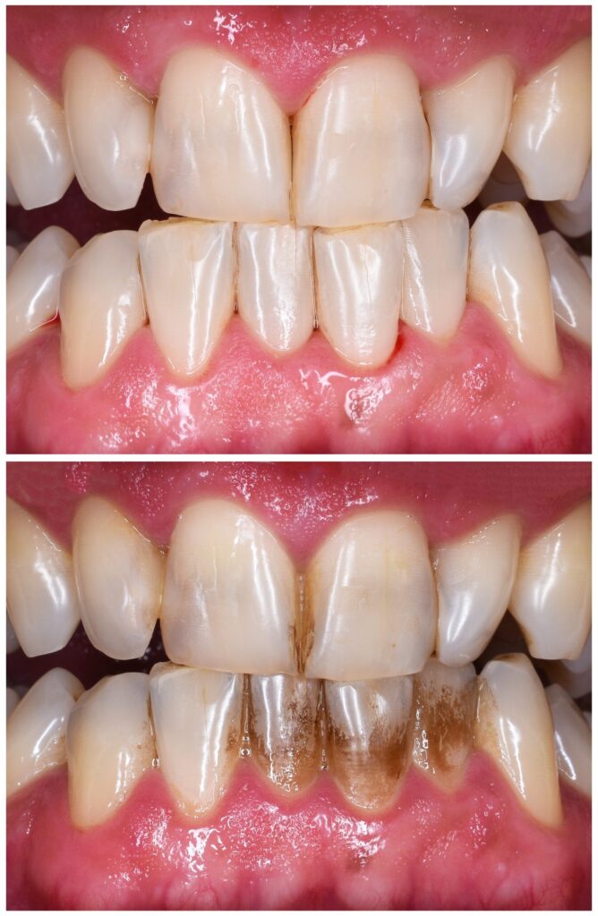 A before and after photo showing the effects of a deep cleaning