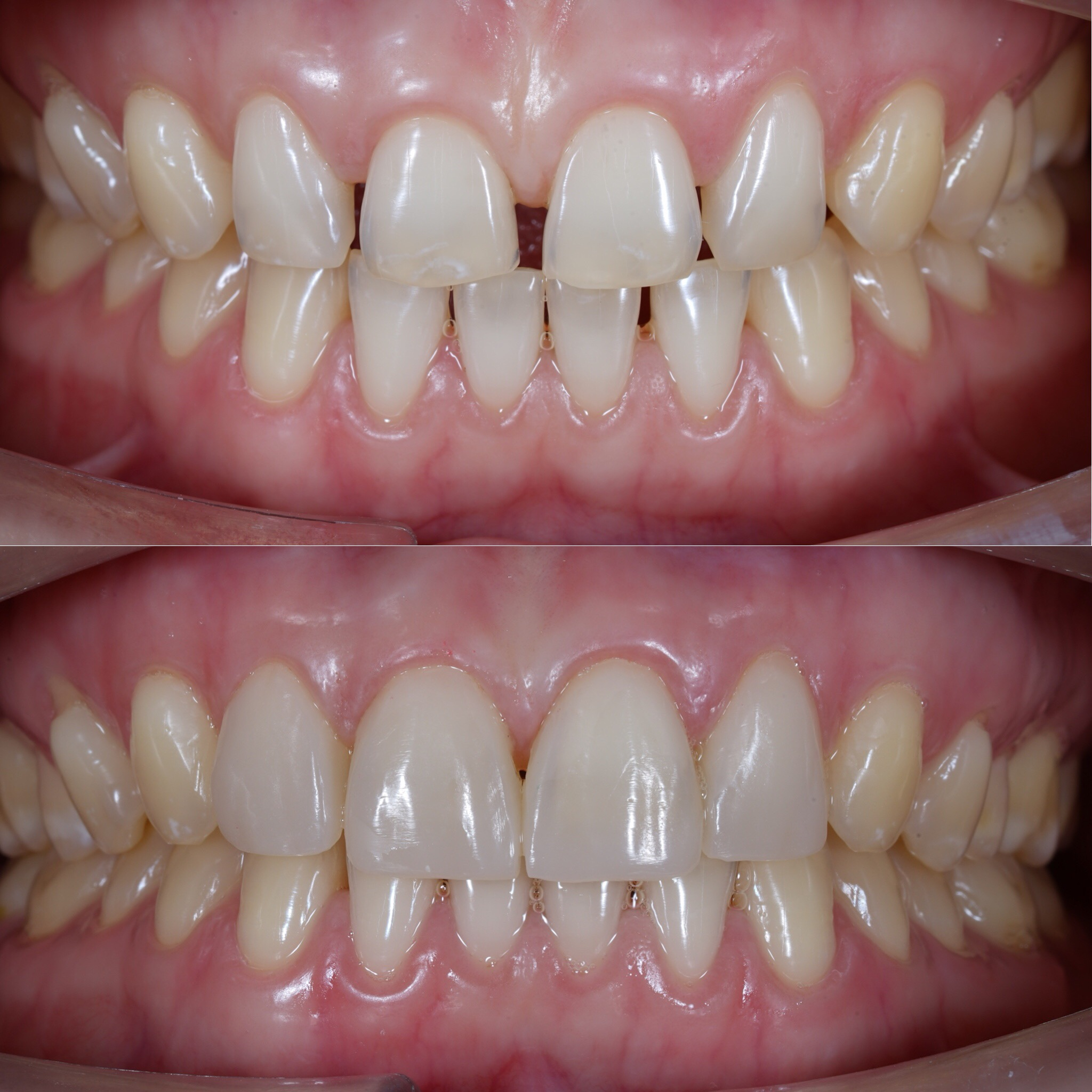 Composite veneers before and after - diastema closure