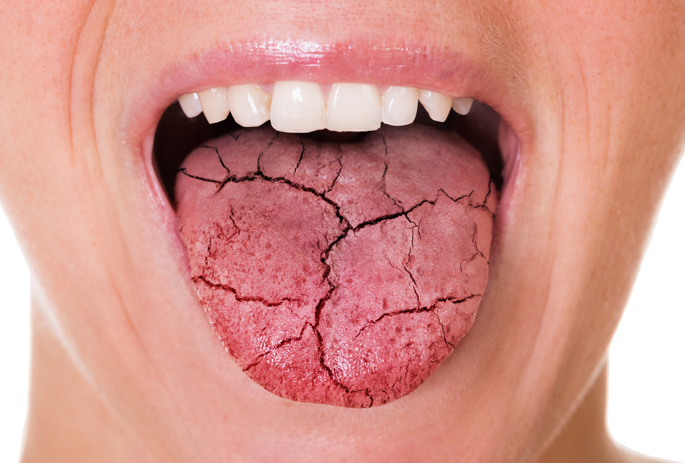 A woman with dry mouth sticks out her dry, cracked, tongue