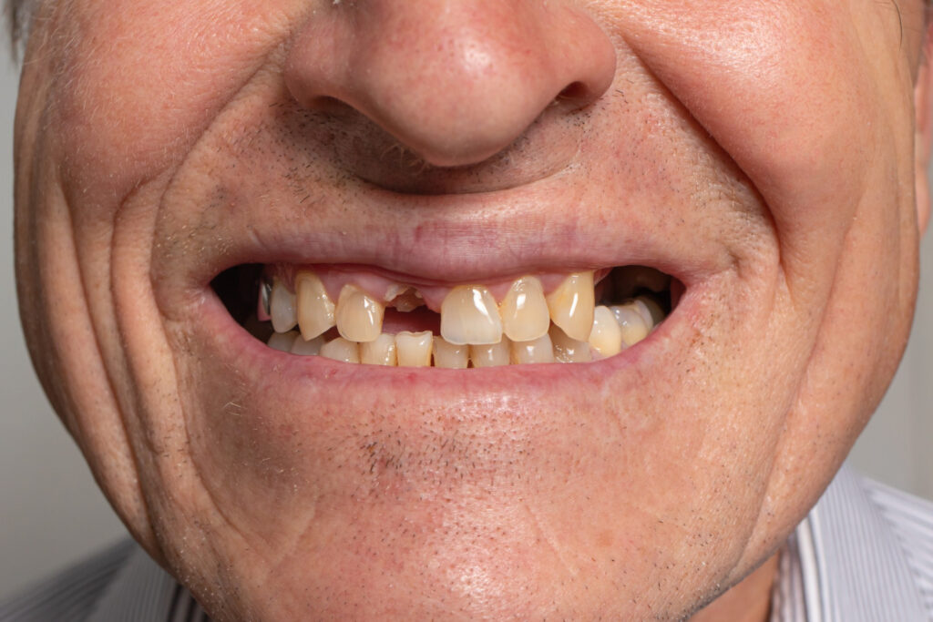An old man lost a central incisor