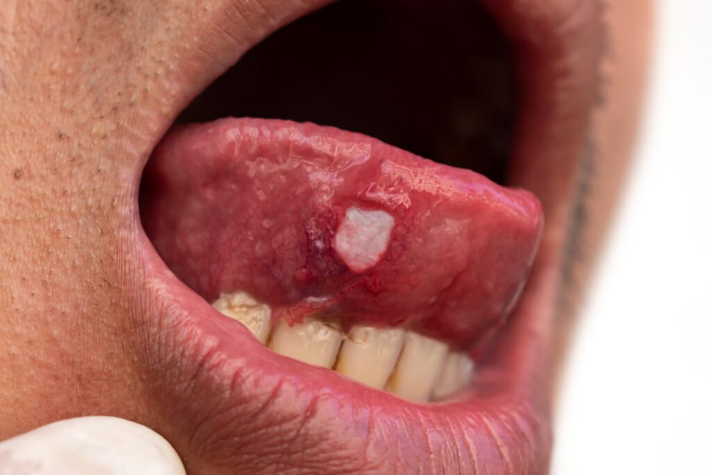Possible early cancerous lesion of the tongue