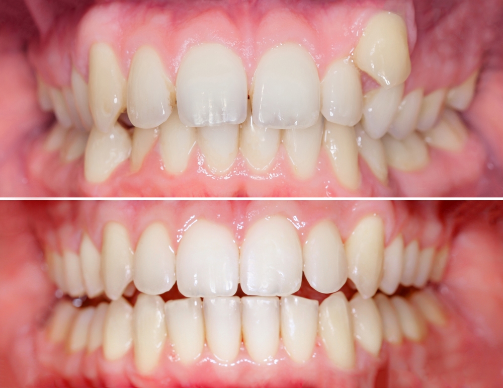 Before and after orthodontics, canine tooth moved into position