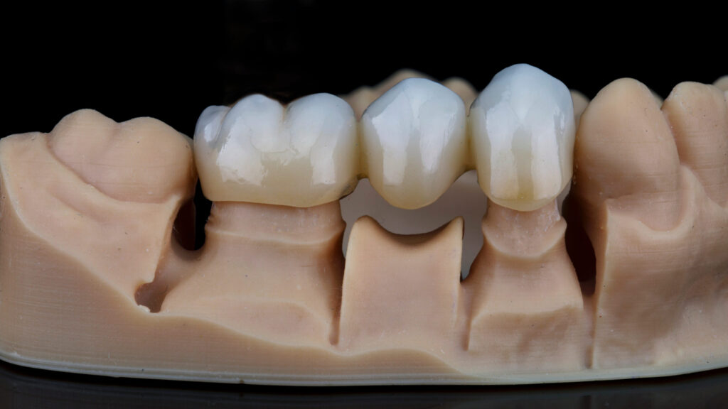 Dental Bridge on a stone model