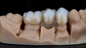Dental Bridge on a stone model