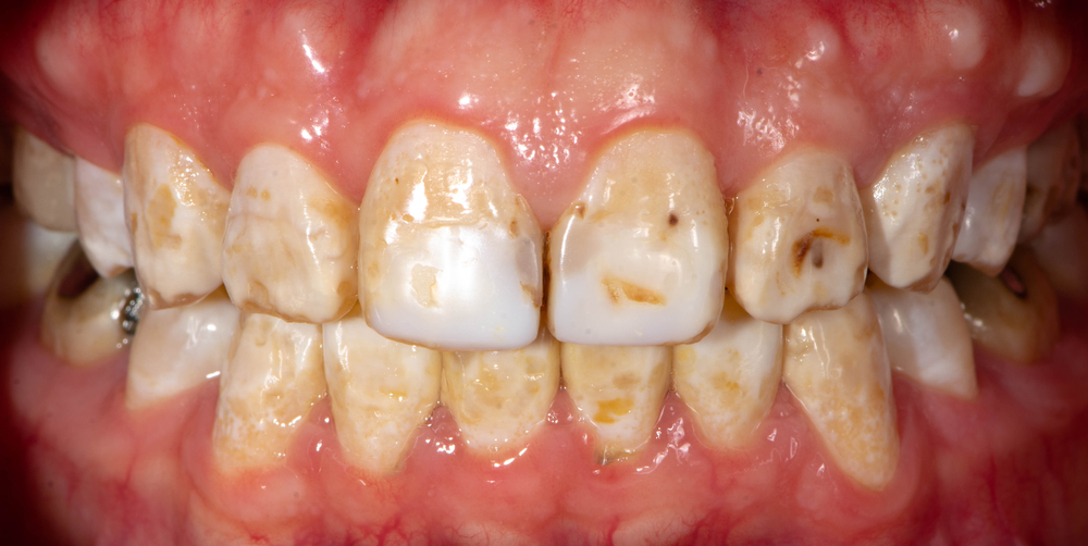 Closeup of teeth showing severe dental fluorosis