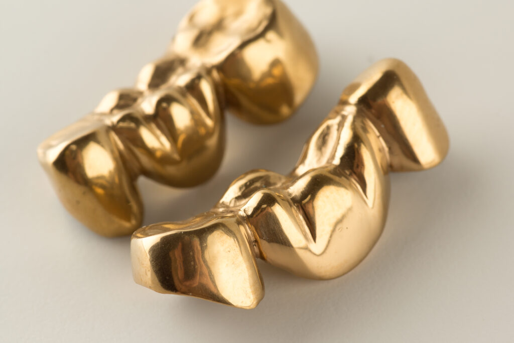 Gold dental bridge