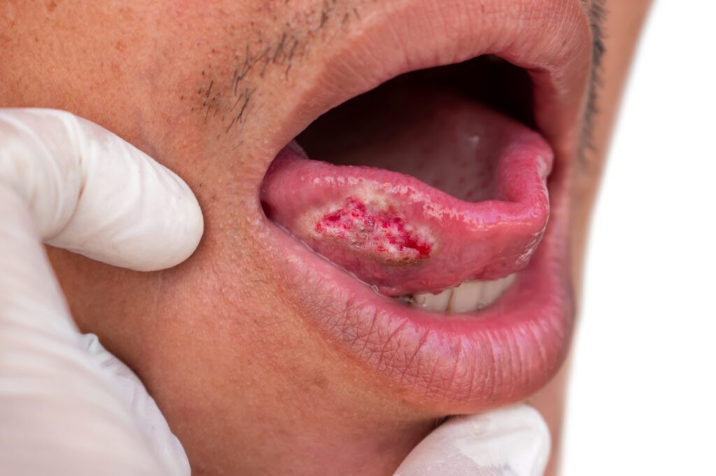 Squamous Cell Carcinoma of the tongue