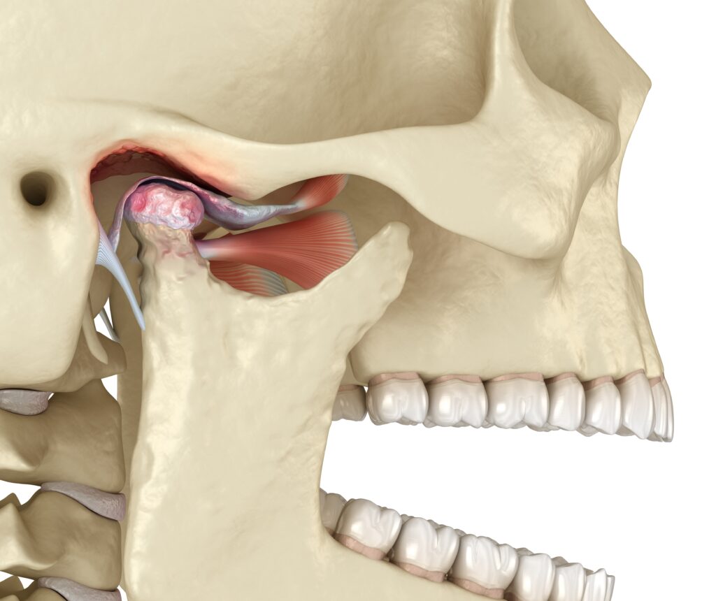 A 3D representation of TMJ Disorders