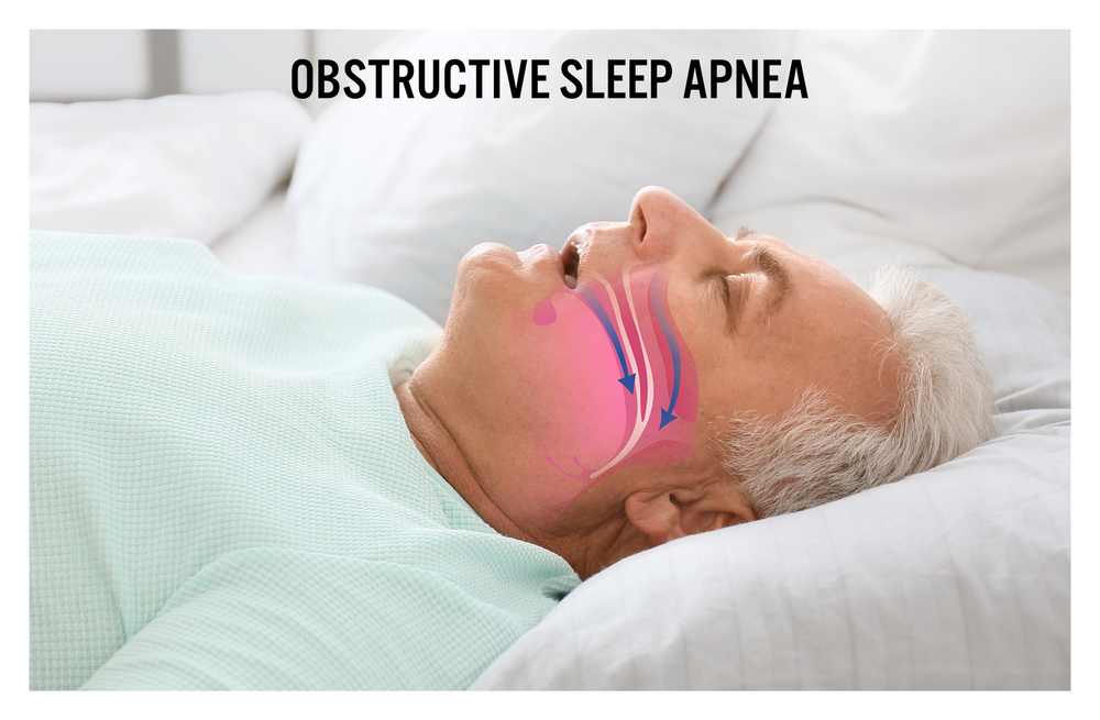 Illustration showing a man with Obstructive Sleep Apnea (osa) snoring in bed