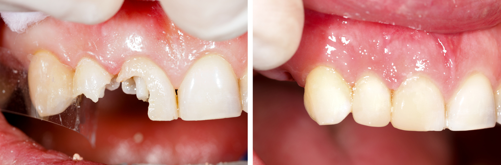Broken teeth before and after photo
