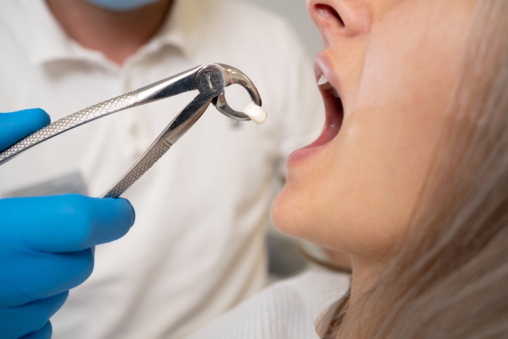 A dentist extracts a broken tooth from a female patient's open mouth