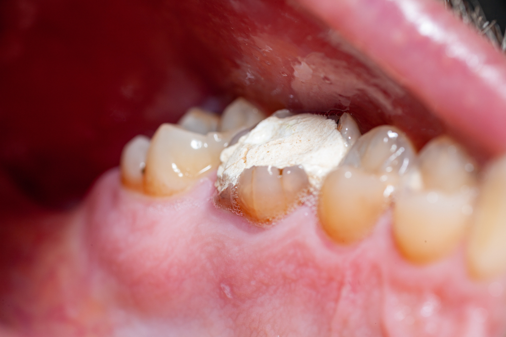 A broken tooth (molar) with a temporary filling