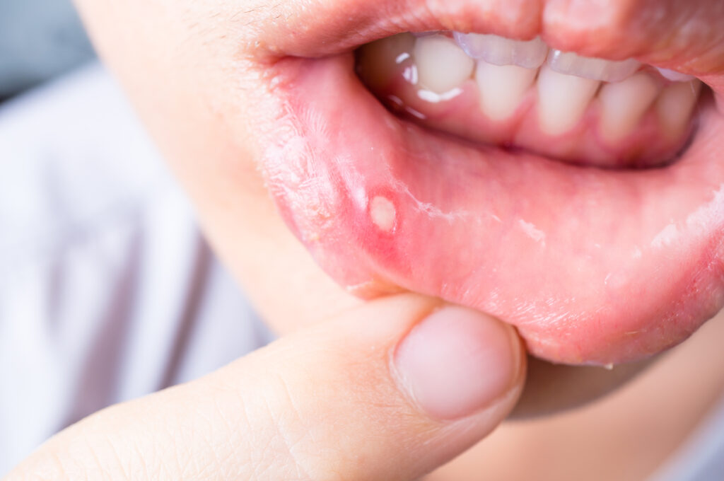 A child pulls their bottom lip away to reveal a canker sore.