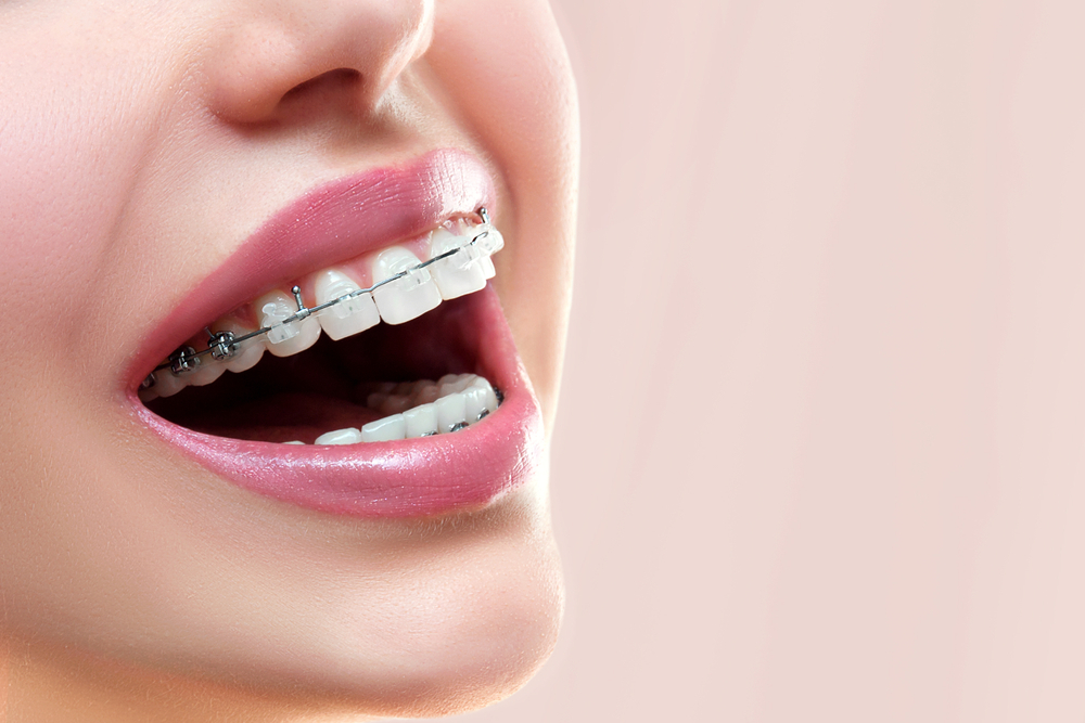 A woman smiles with ceramic braces