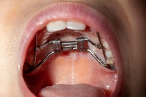 Rapid maxillary palatal expander