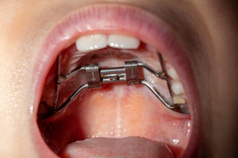 Maxillary Palatal Expanders: Guiding Facial Growth