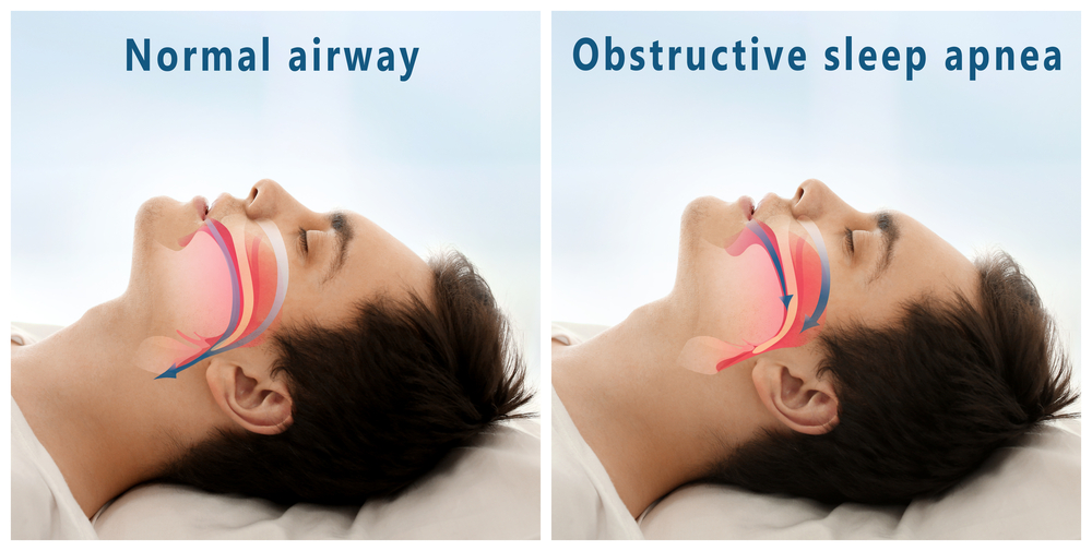 A diagram comparing Obstructive Sleep Apnea (OSA) with a normal airway