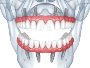 All-on-4 3D rendering upper and lower fixed implant dentures
